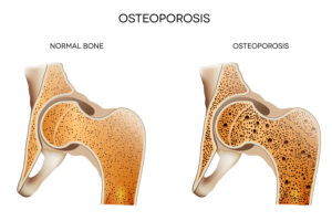 Elder Care Webb City, MO: Managing Osteoporosis